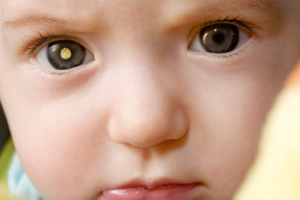 Cos'è il retinoblastoma: tumore maligno che colpisce in età pediatrica